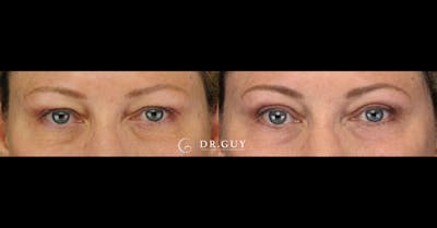 Upper Blepharoplasty Before & After Gallery - Patient 401497 - Image 1