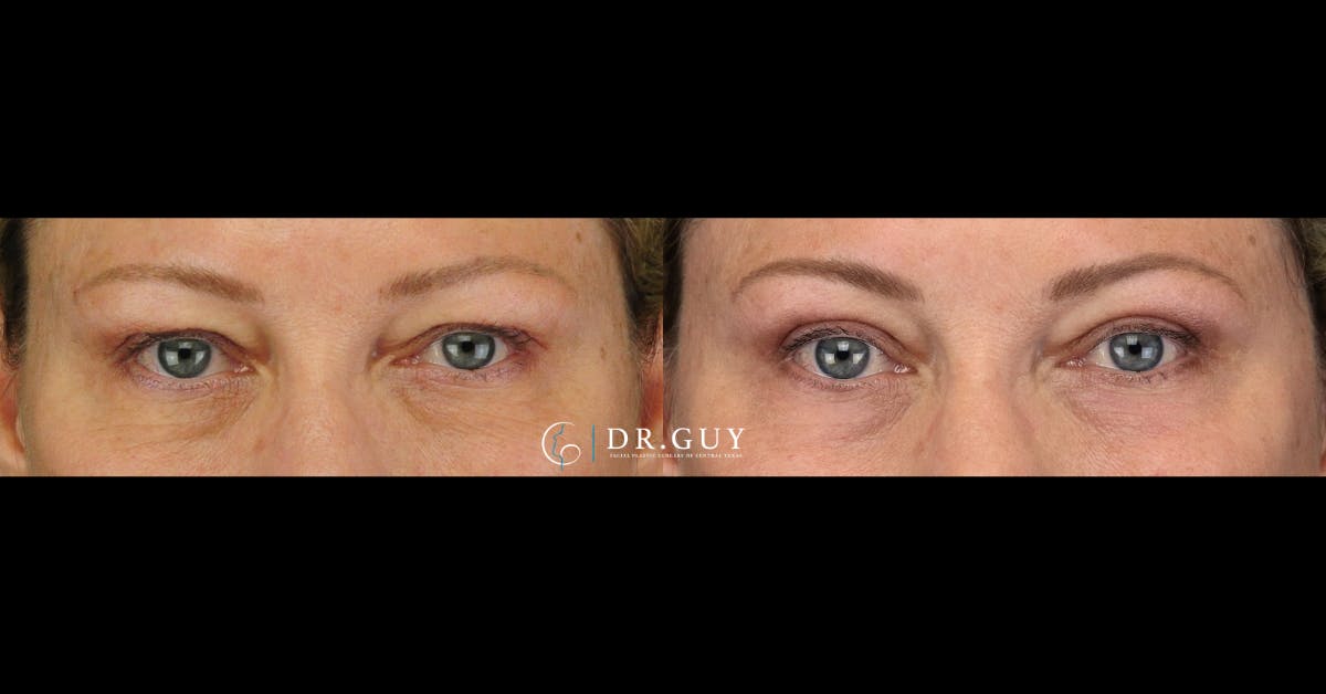 Upper Blepharoplasty Before & After Gallery - Patient 401497 - Image 1