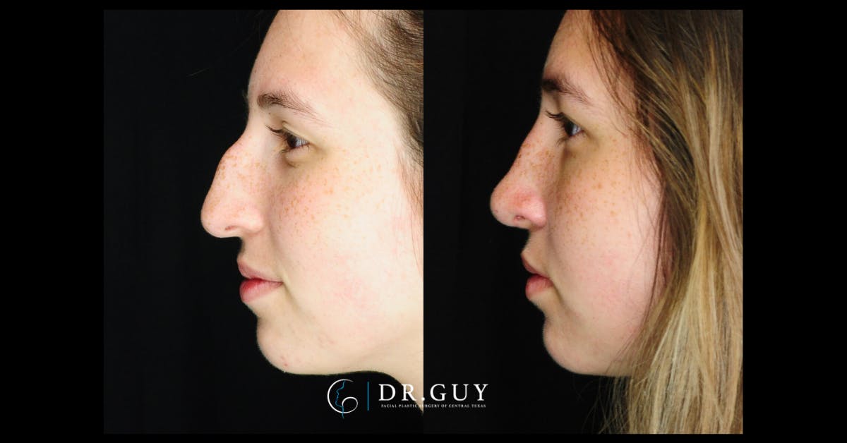 Surgical Rhinoplasty Before & After Gallery - Patient 282257 - Image 2