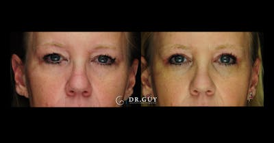Browlift Before & After Gallery - Patient 134741 - Image 1