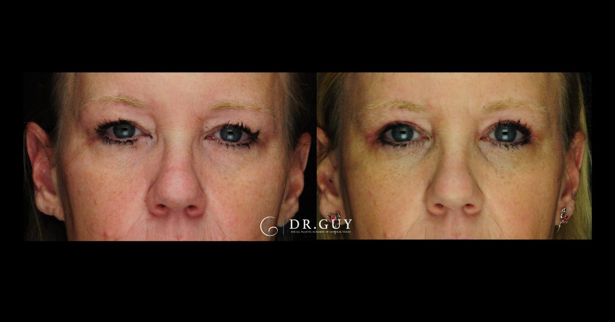 Browlift Before & After Gallery - Patient 134741 - Image 1