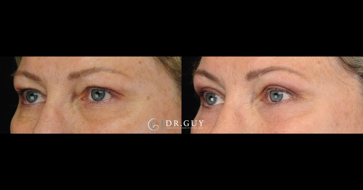 Upper Blepharoplasty Before & After Gallery - Patient 401497 - Image 2