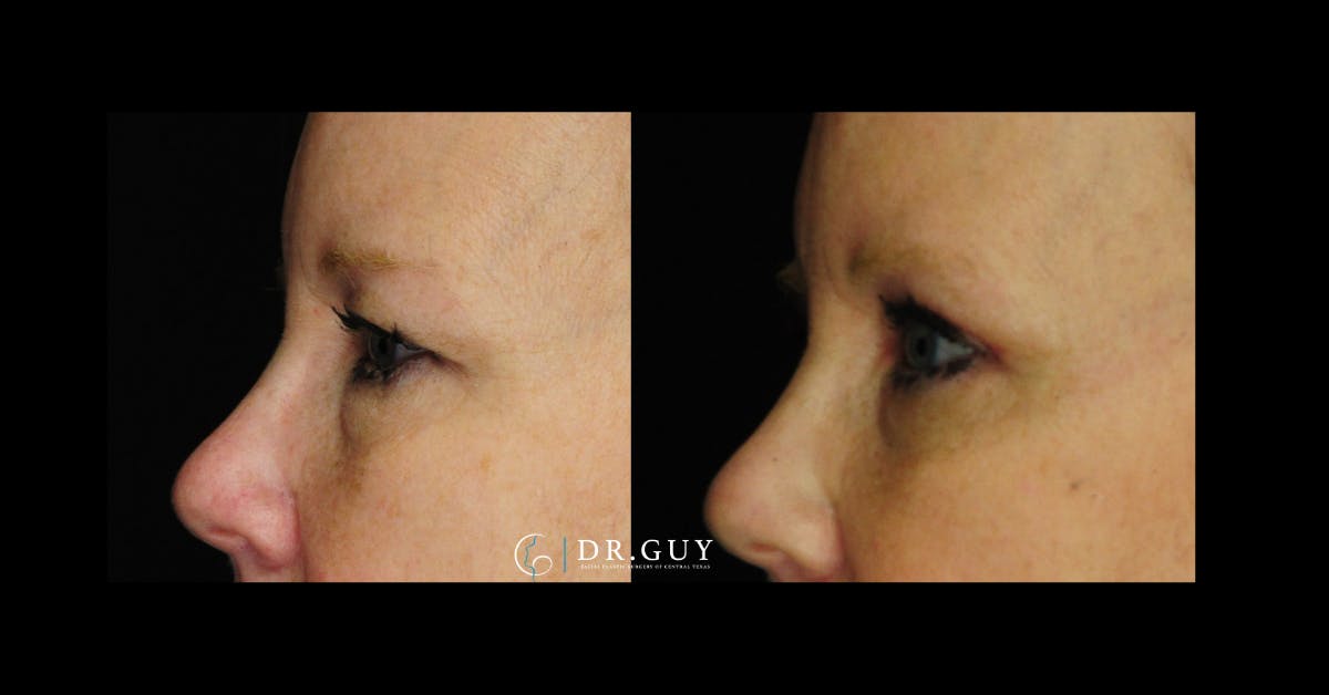Browlift Before & After Gallery - Patient 134741 - Image 2