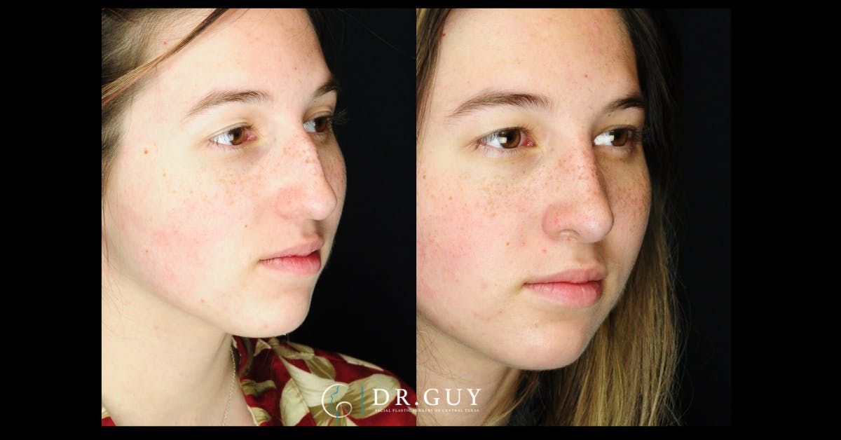 Surgical Rhinoplasty Before & After Gallery - Patient 282257 - Image 3