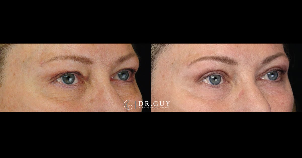 Upper Blepharoplasty Before & After Gallery - Patient 401497 - Image 3