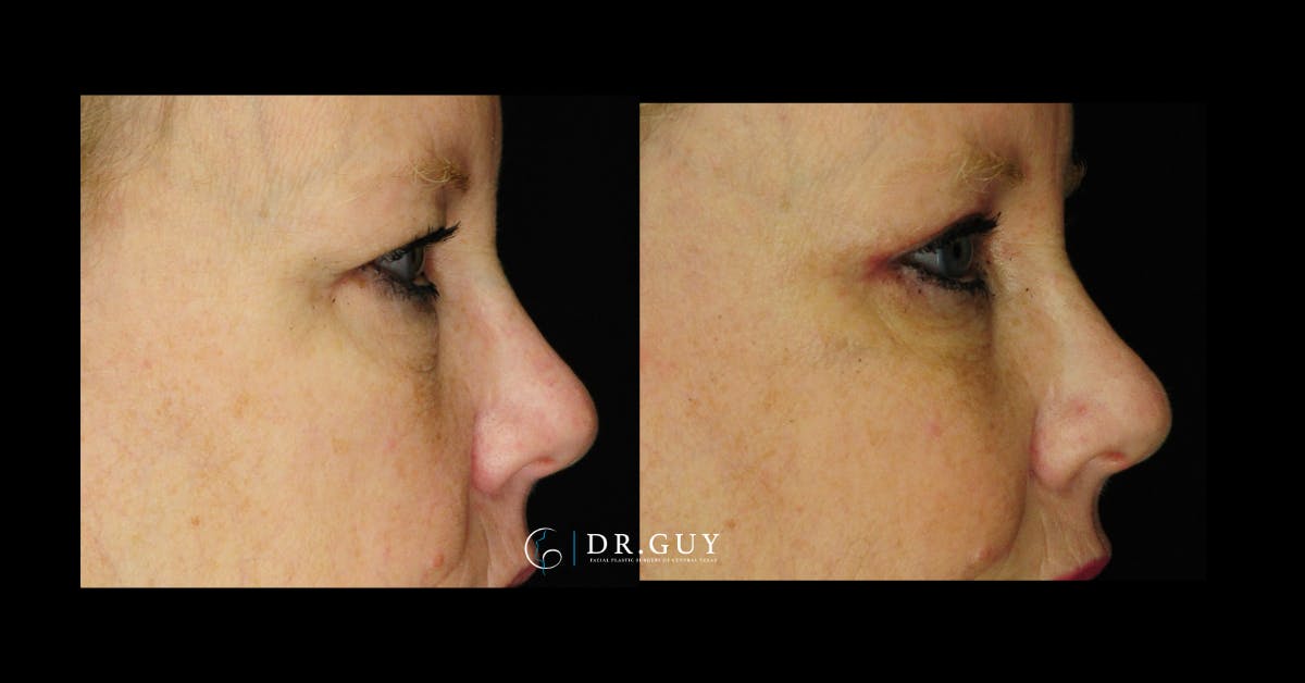 Browlift Before & After Gallery - Patient 134741 - Image 3