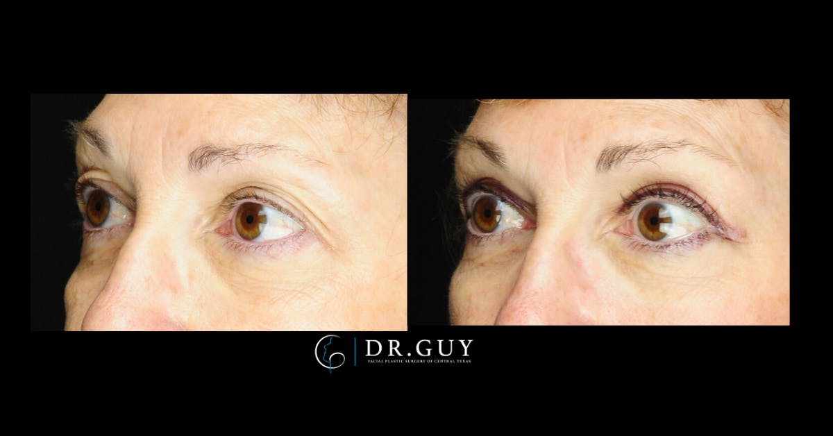 Browlift Before & After Gallery - Patient 134741 - Image 4