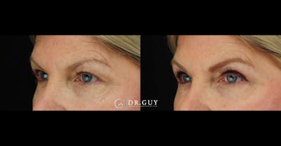 Upper Blepharoplasty Before & After Gallery - Patient 112953 - Image 1