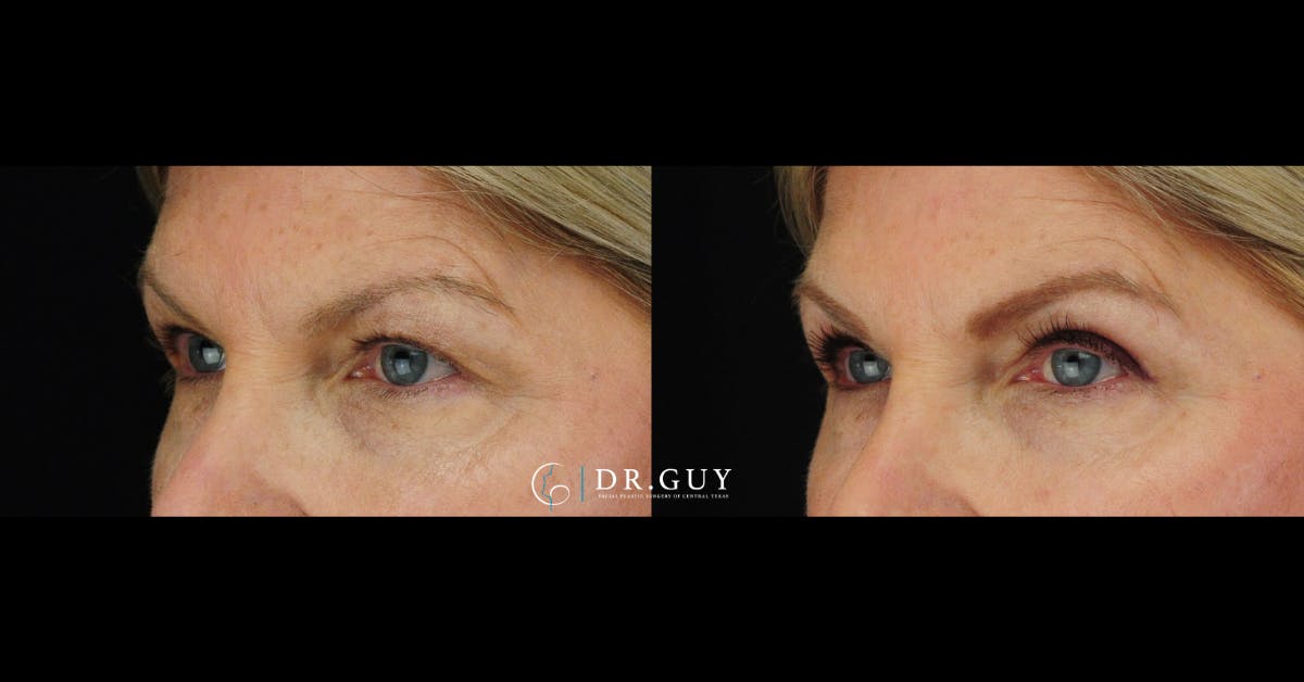 Upper Blepharoplasty Before & After Gallery - Patient 112953 - Image 1