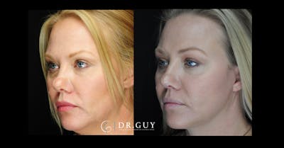 Surgical Rhinoplasty Before & After Gallery - Patient 464931 - Image 1