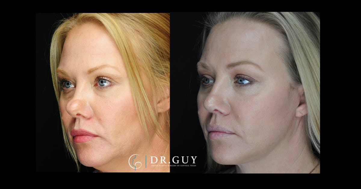 Surgical Rhinoplasty Before & After Gallery - Patient 464931 - Image 1