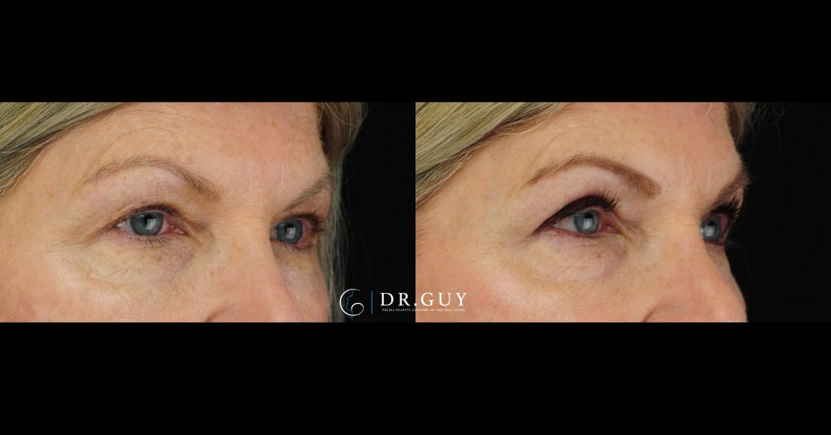 Upper Blepharoplasty Before & After Gallery - Patient 112953 - Image 2