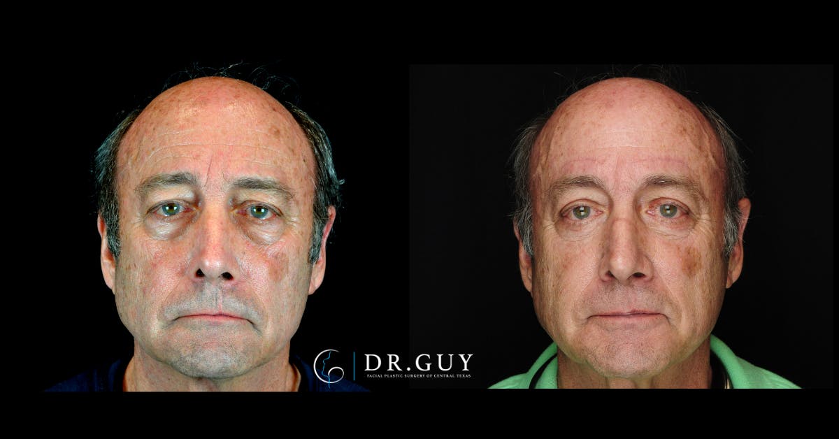 Browlift Before & After Gallery - Patient 333254 - Image 1