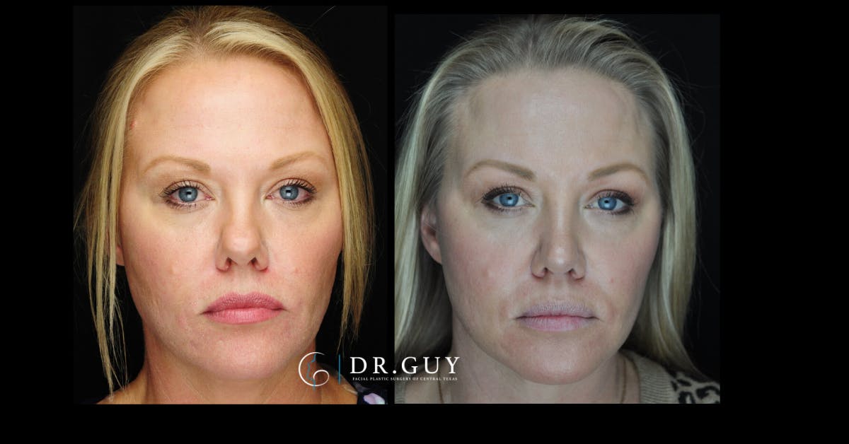 Surgical Rhinoplasty Before & After Gallery - Patient 464931 - Image 2