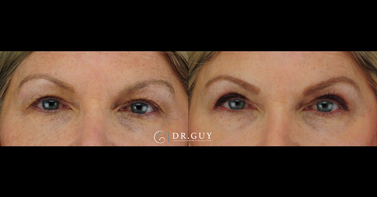 Upper Blepharoplasty Before & After Gallery - Patient 112953 - Image 3