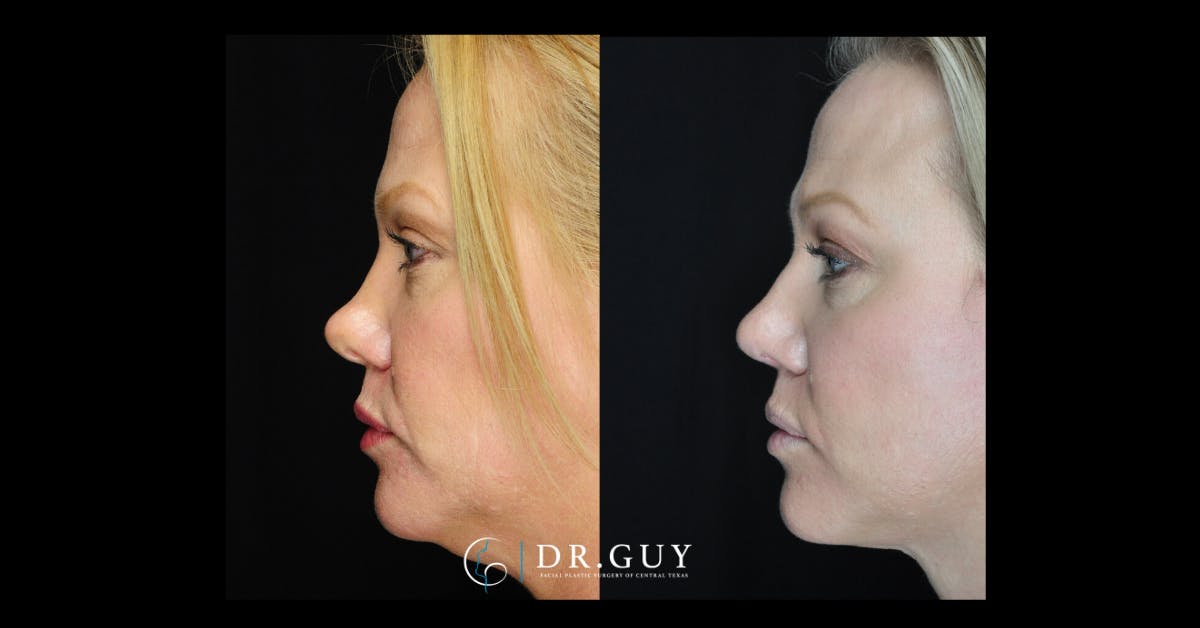 Surgical Rhinoplasty Before & After Gallery - Patient 464931 - Image 3