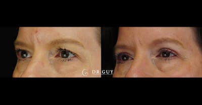 Upper Blepharoplasty Before & After Gallery - Patient 349154 - Image 1