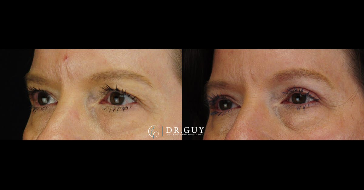 Upper Blepharoplasty Before & After Gallery - Patient 349154 - Image 1