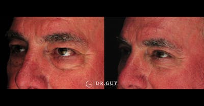 Browlift Before & After Gallery - Patient 138424 - Image 1
