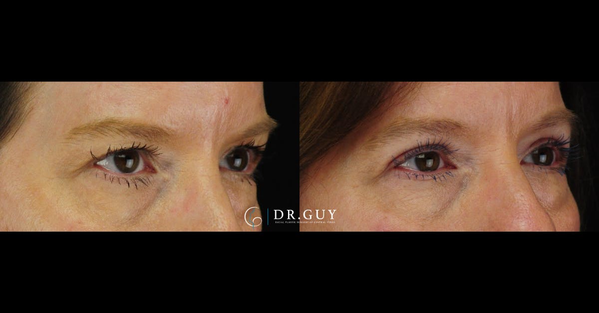 Upper Blepharoplasty Before & After Gallery - Patient 349154 - Image 2