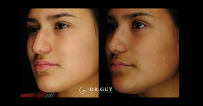 Surgical Rhinoplasty Before & After Gallery - Patient 425741 - Image 1
