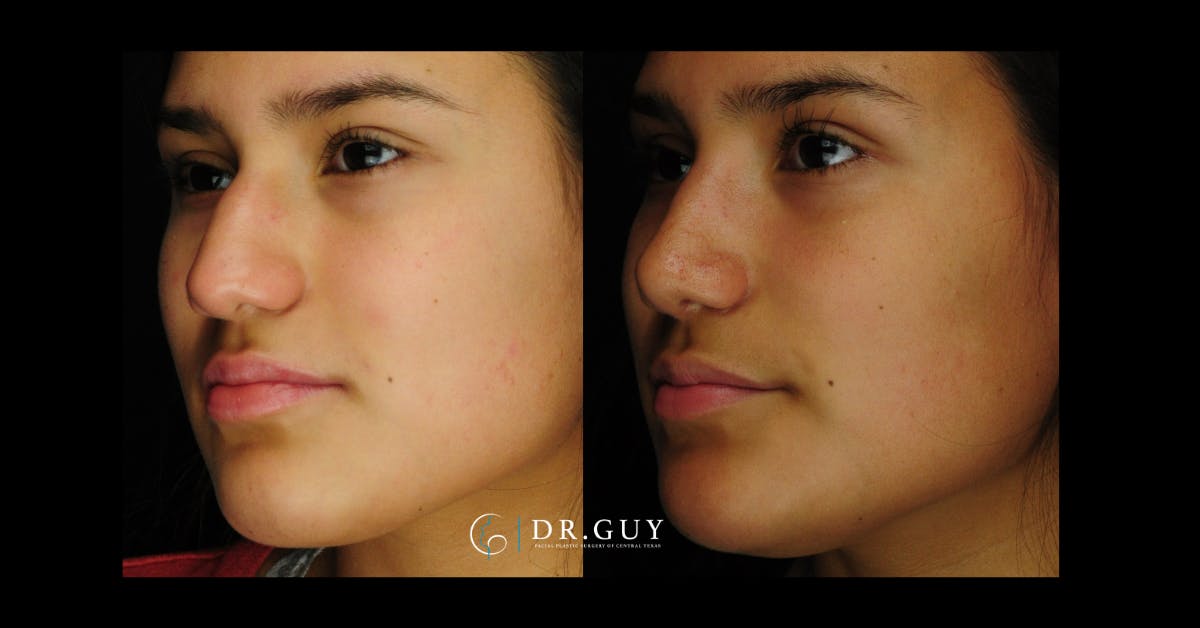 Surgical Rhinoplasty Before & After Gallery - Patient 425741 - Image 1