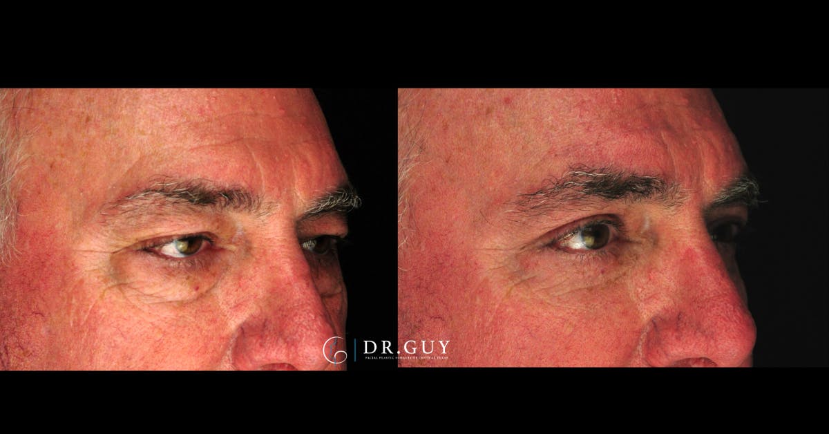Browlift Before & After Gallery - Patient 138424 - Image 2