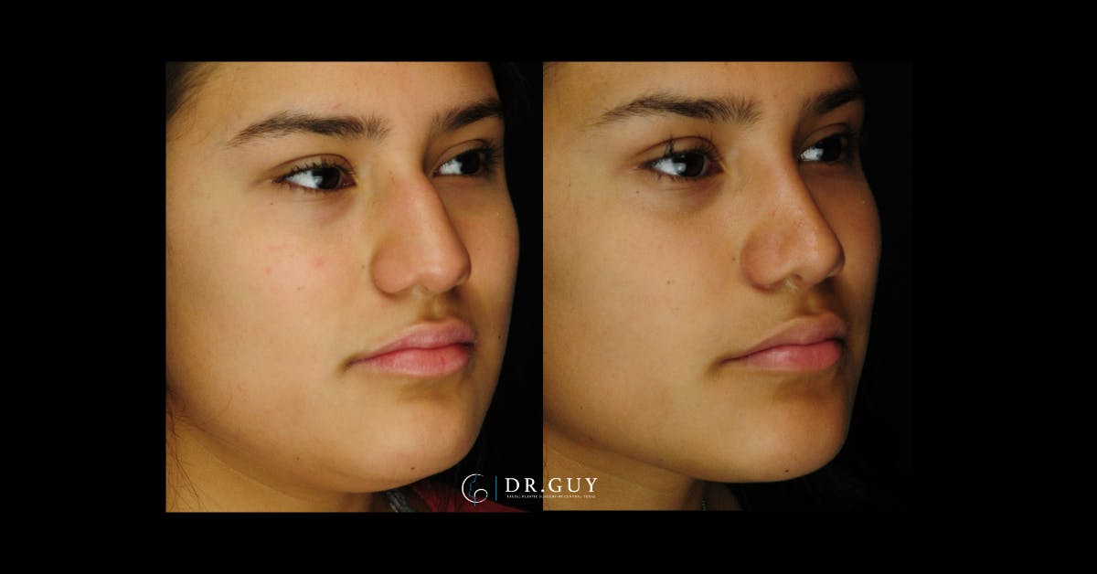 Surgical Rhinoplasty Before & After Gallery - Patient 425741 - Image 2