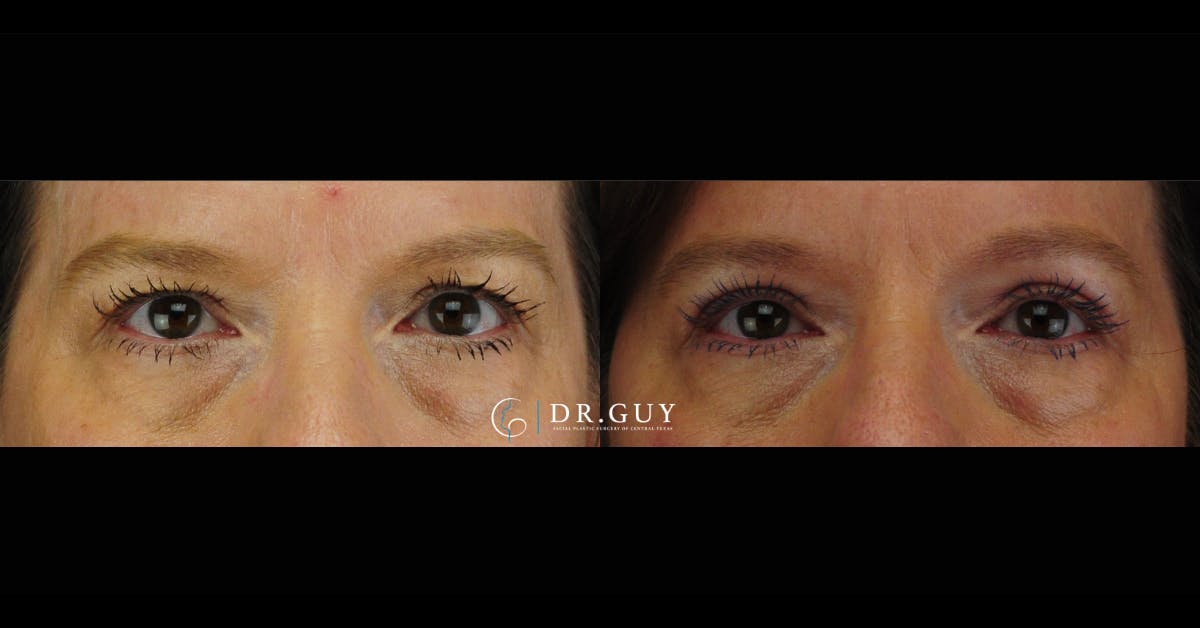 Upper Blepharoplasty Before & After Gallery - Patient 349154 - Image 3