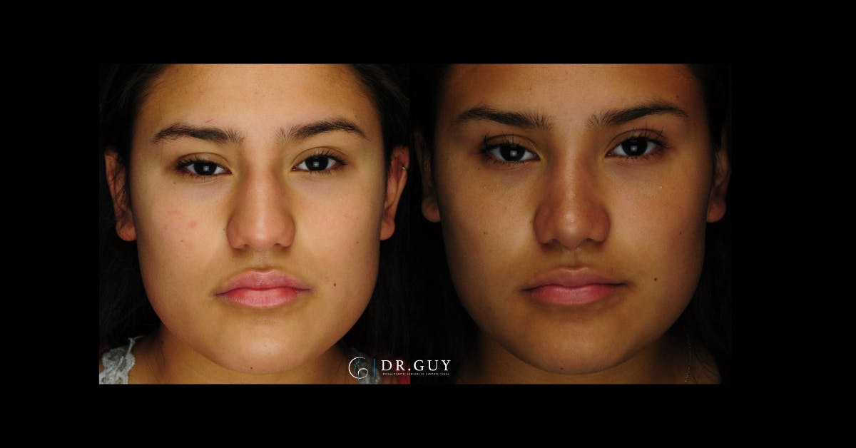 Surgical Rhinoplasty Before & After Gallery - Patient 425741 - Image 3
