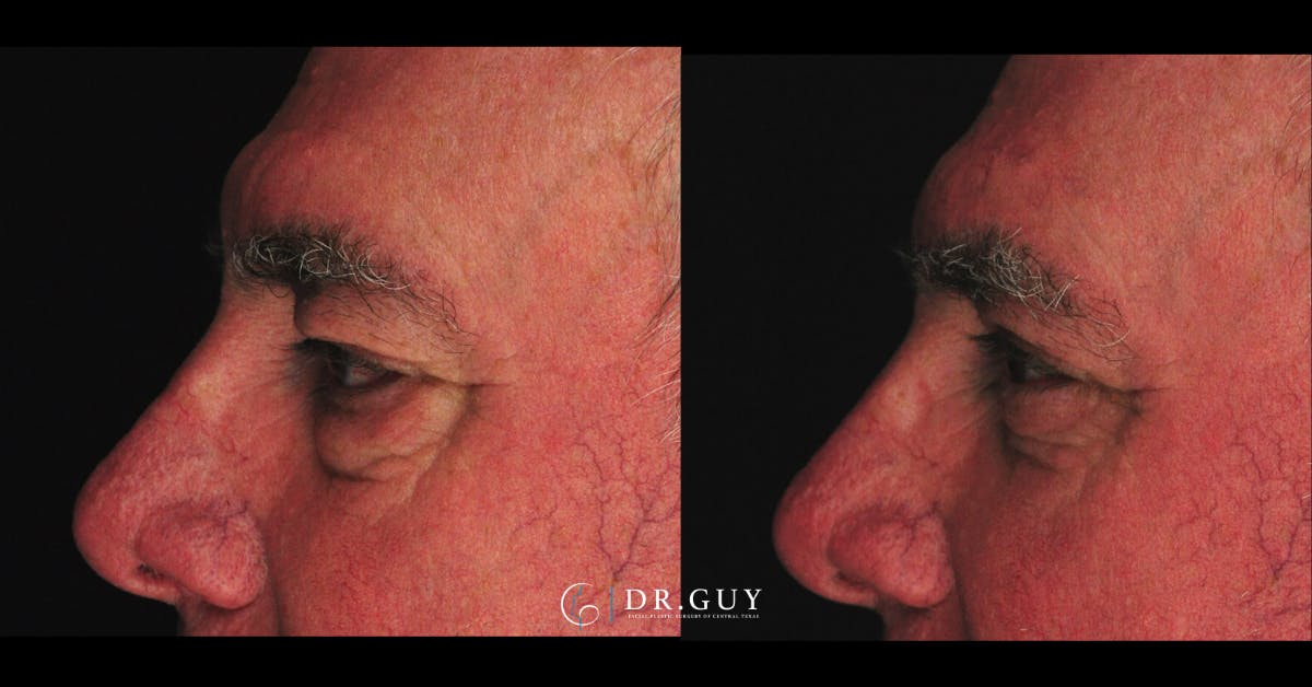 Browlift Before & After Gallery - Patient 138424 - Image 4