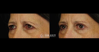 Upper Blepharoplasty Before & After Gallery - Patient 226777 - Image 1