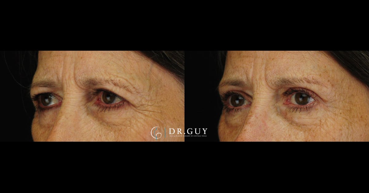 Upper Blepharoplasty Before & After Gallery - Patient 226777 - Image 1