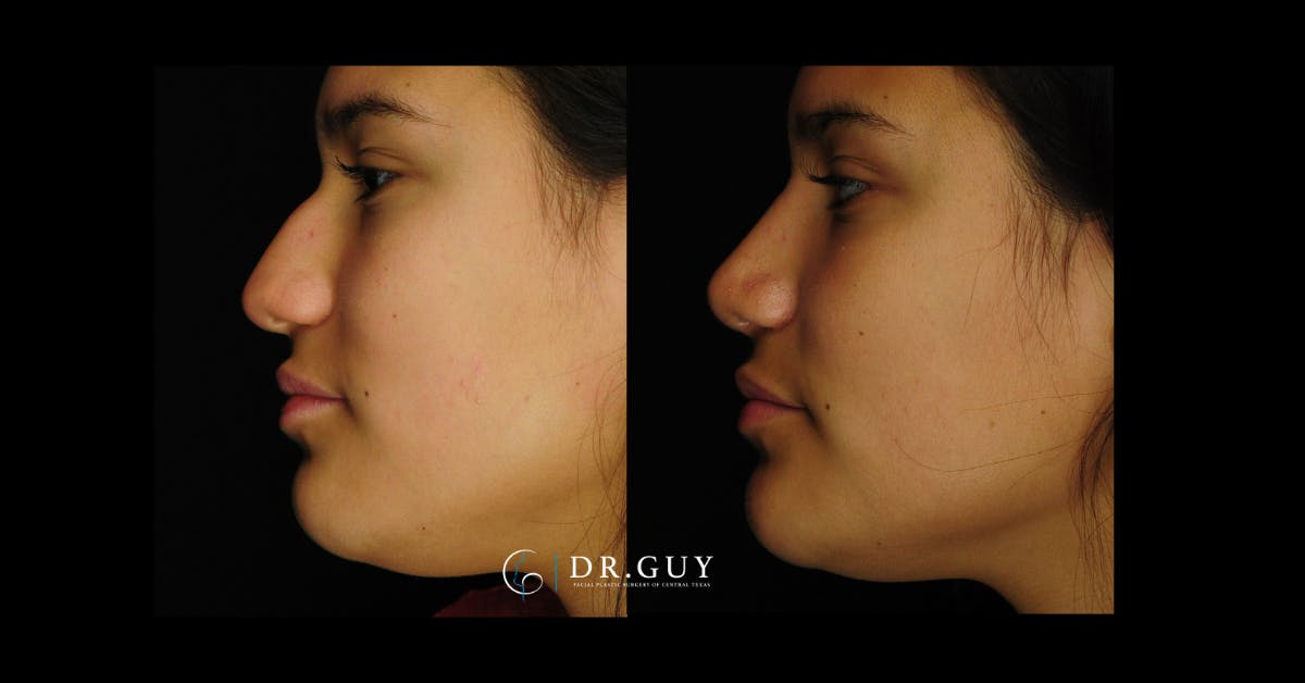 Surgical Rhinoplasty Before & After Gallery - Patient 425741 - Image 4