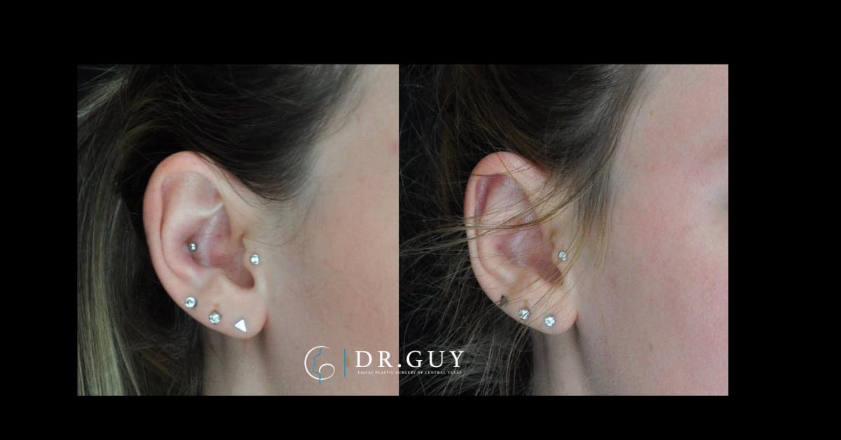 Otoplasty Before & After Gallery - Patient 341625 - Image 1