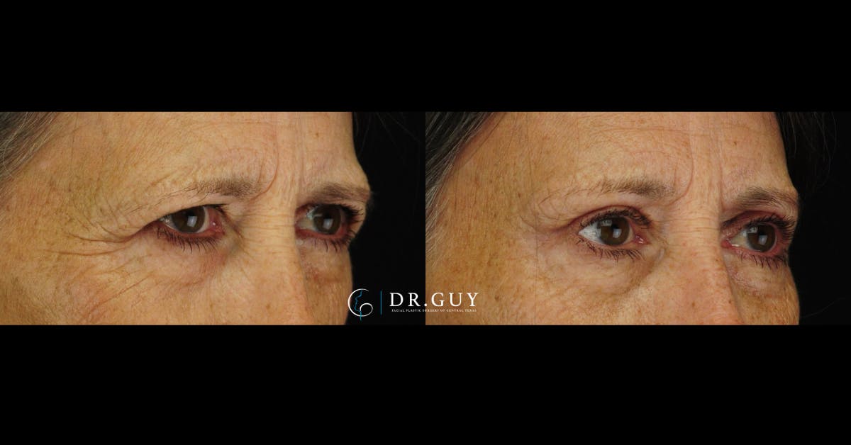 Upper Blepharoplasty Before & After Gallery - Patient 226777 - Image 2