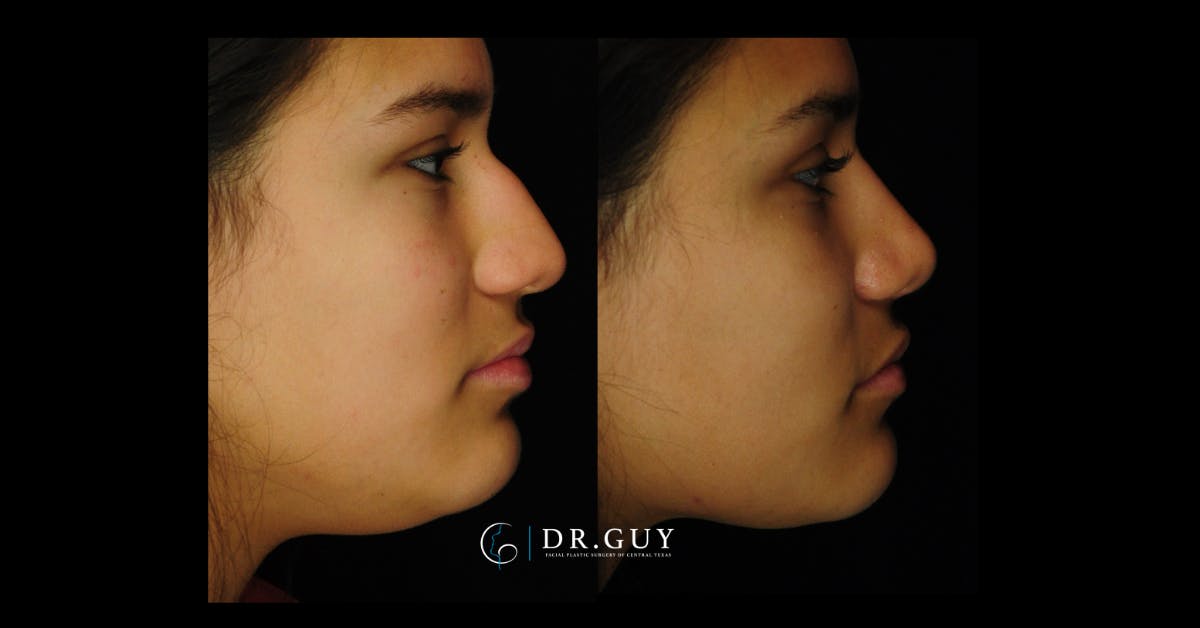 Surgical Rhinoplasty Before & After Gallery - Patient 425741 - Image 5
