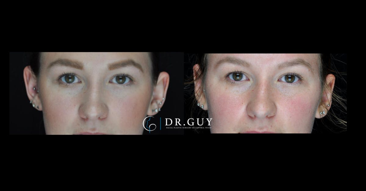 Otoplasty Before & After Gallery - Patient 341625 - Image 2
