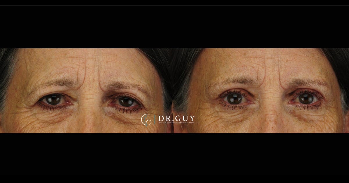 Upper Blepharoplasty Before & After Gallery - Patient 226777 - Image 3
