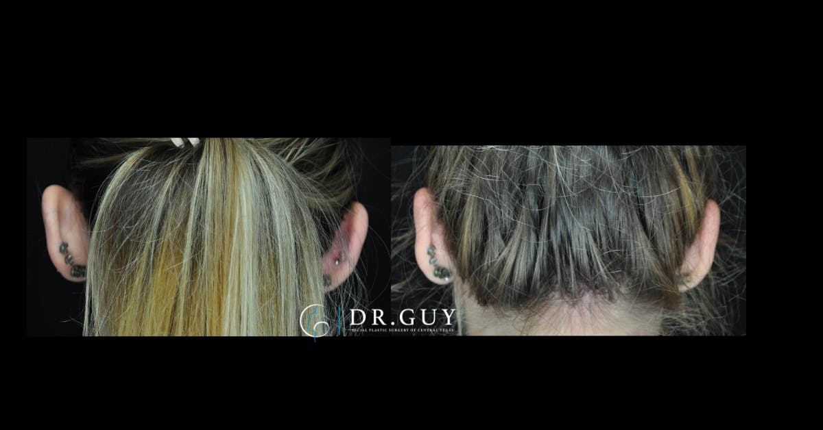 Otoplasty Before & After Gallery - Patient 341625 - Image 3