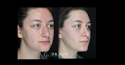 Surgical Rhinoplasty Before & After Gallery - Patient 354829 - Image 1