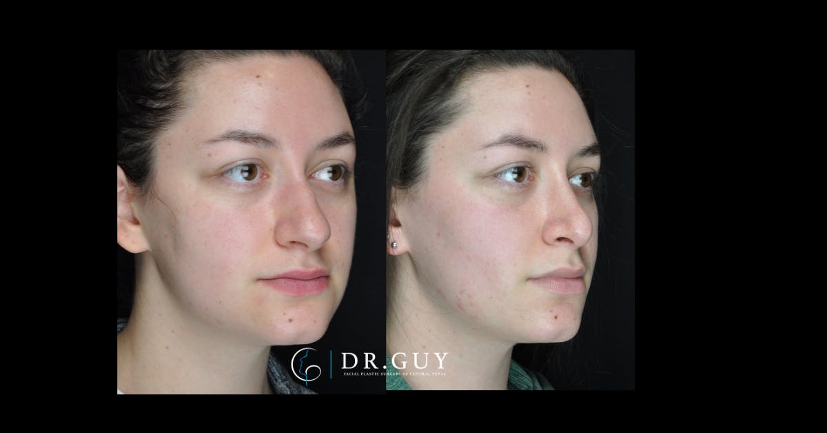 Surgical Rhinoplasty Before & After Gallery - Patient 354829 - Image 1