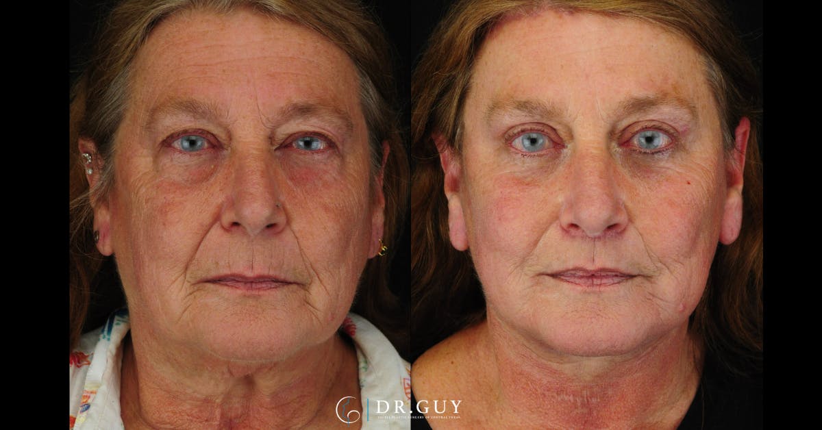 Upper Blepharoplasty Before & After Gallery - Patient 149206 - Image 1