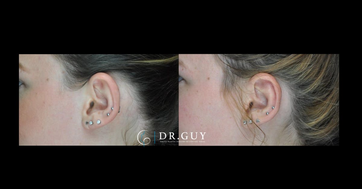 Otoplasty Before & After Gallery - Patient 341625 - Image 4