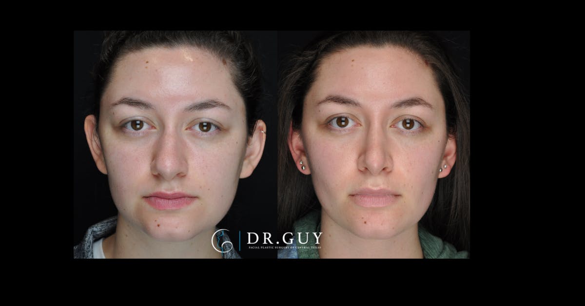 Surgical Rhinoplasty Before & After Gallery - Patient 354829 - Image 2