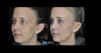 Otoplasty Before & After Gallery - Patient 260191 - Image 1