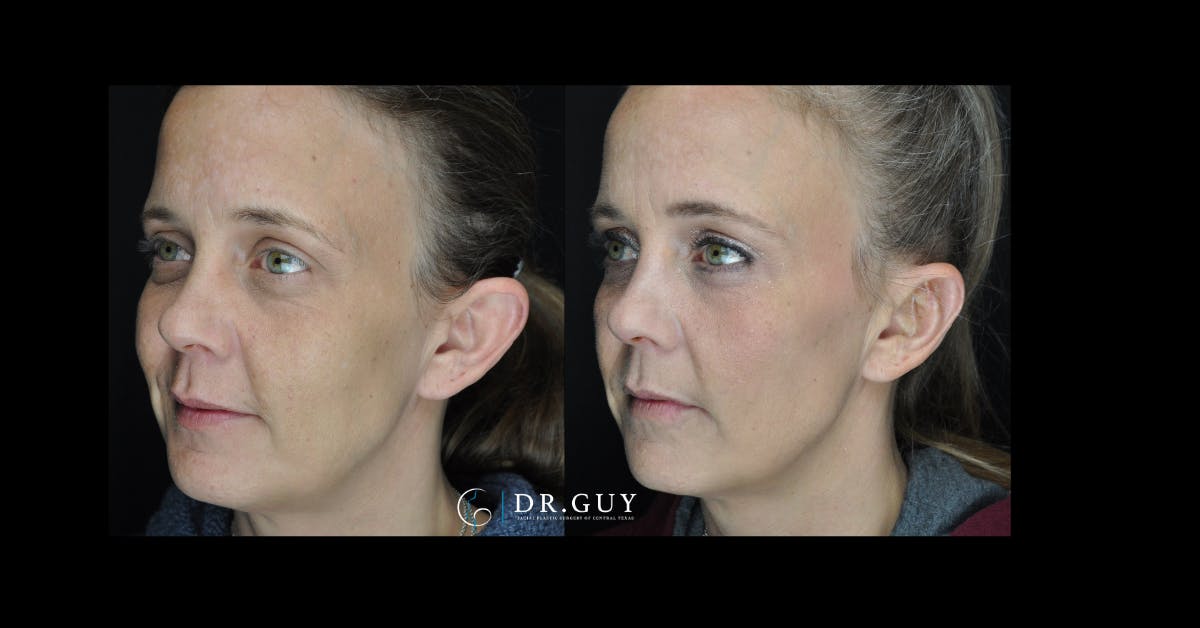 Otoplasty Before & After Gallery - Patient 260191 - Image 1