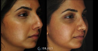 Surgical Rhinoplasty Before & After Gallery - Patient 348654 - Image 1