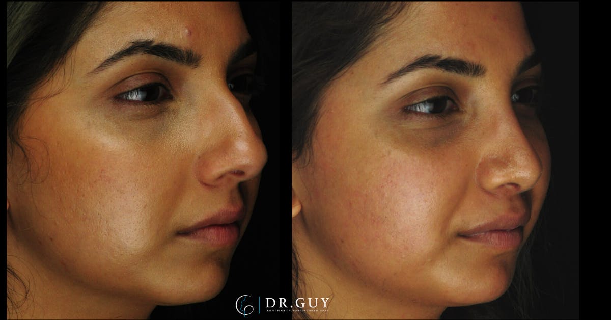 Surgical Rhinoplasty Before & After Gallery - Patient 348654 - Image 1