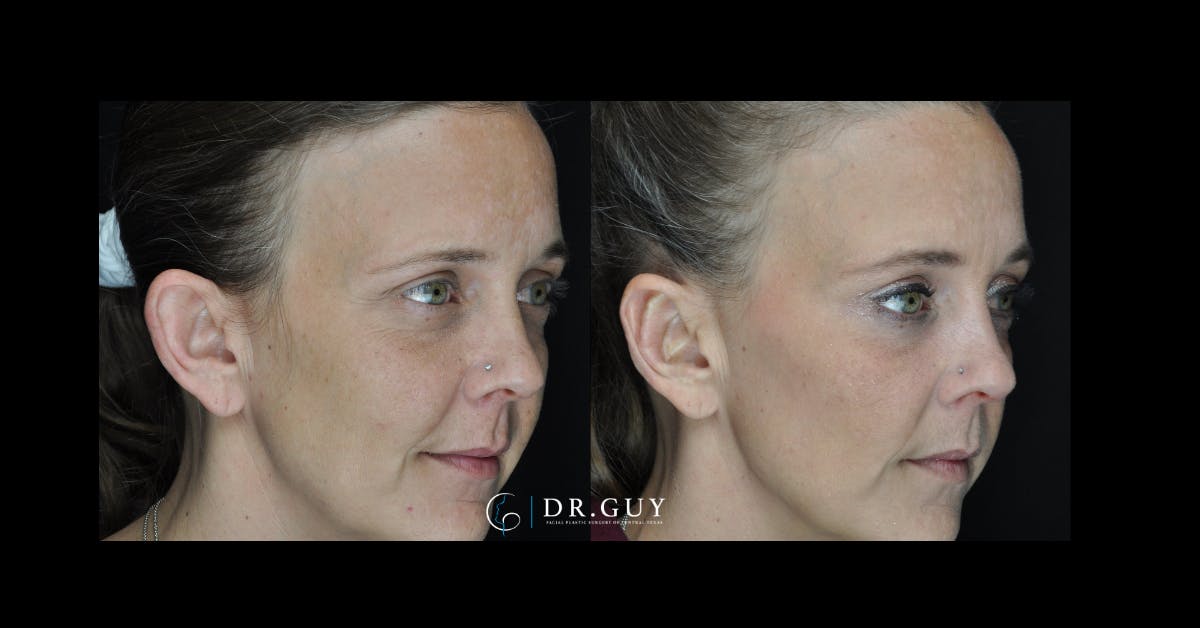 Otoplasty Before & After Gallery - Patient 260191 - Image 2